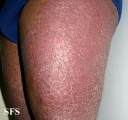 pityriasis rubra pilaris