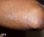 pityriasis rubra pilaris