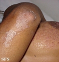 pityriasis rubra pilaris