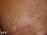 pityriasis rubra pilaris