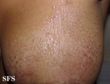 pityriasis rubra pilaris