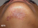 pityriasis rubra pilaris