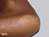 pityriasis rubra pilaris