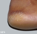 pityriasis rubra pilaris