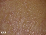 pityriasis rubra pilaris