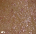 pityriasis rubra pilaris