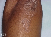 pityriasis rubra pilaris