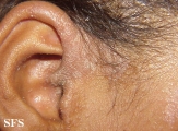 pityriasis rubra pilaris