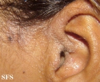pityriasis rubra pilaris