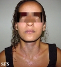 pityriasis rubra pilaris