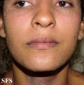 pityriasis rubra pilaris