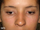 pityriasis rubra pilaris