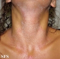 pityriasis rubra pilaris