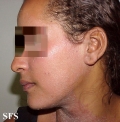 pityriasis rubra pilaris