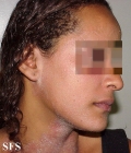 pityriasis rubra pilaris