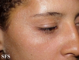pityriasis rubra pilaris
