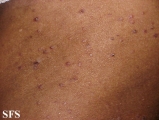 pityriasis rubra pilaris
