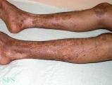 pityriasis rubra pilaris
