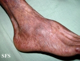 pityriasis rubra pilaris