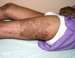 pityriasis rubra pilaris
