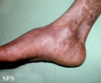pityriasis rubra pilaris