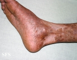 pityriasis rubra pilaris