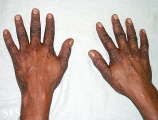 pityriasis rubra pilaris