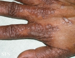 pityriasis rubra pilaris