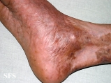 pityriasis rubra pilaris