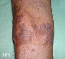 pityriasis rubra pilaris