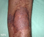 pityriasis rubra pilaris