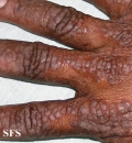pityriasis rubra pilaris