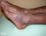 pityriasis rubra pilaris
