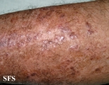 pityriasis rubra pilaris