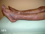 pityriasis rubra pilaris