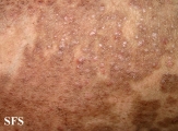 pityriasis rubra pilaris