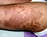 pityriasis rubra pilaris