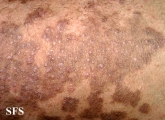 pityriasis rubra pilaris
