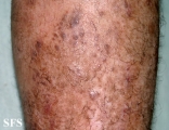 pityriasis rubra pilaris