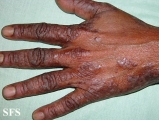 pityriasis rubra pilaris