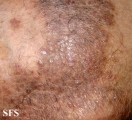 pityriasis rubra pilaris