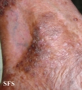pityriasis rubra pilaris