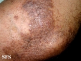 pityriasis rubra pilaris