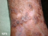 pityriasis rubra pilaris