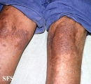 pityriasis rubra pilaris