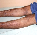 pityriasis rubra pilaris
