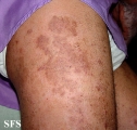 pityriasis rubra pilaris