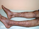 pityriasis rubra pilaris
