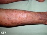 pityriasis rubra pilaris