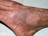 pityriasis rubra pilaris